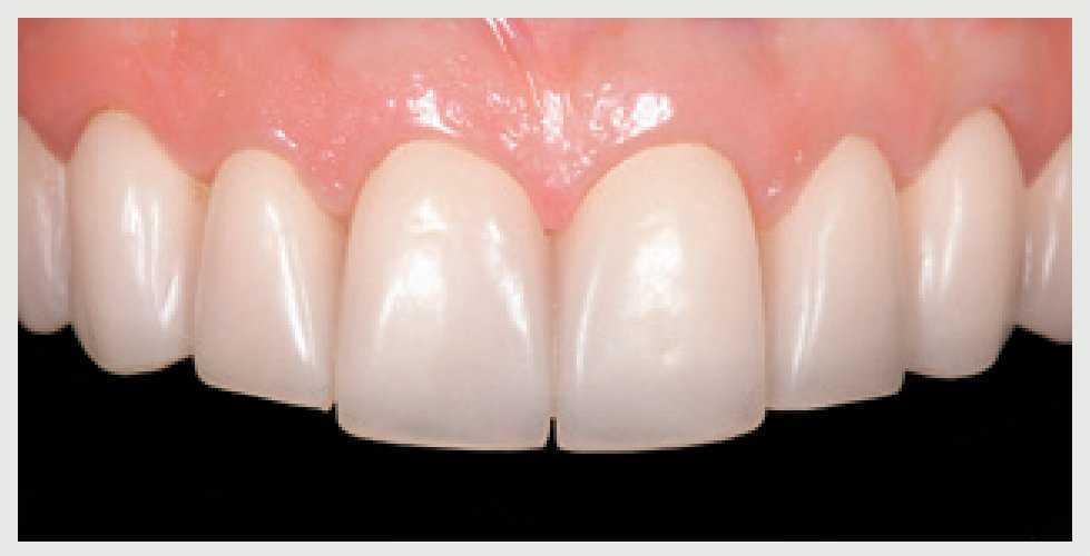 Insuficiente exposición dentaria en el sector anterior Presentación de