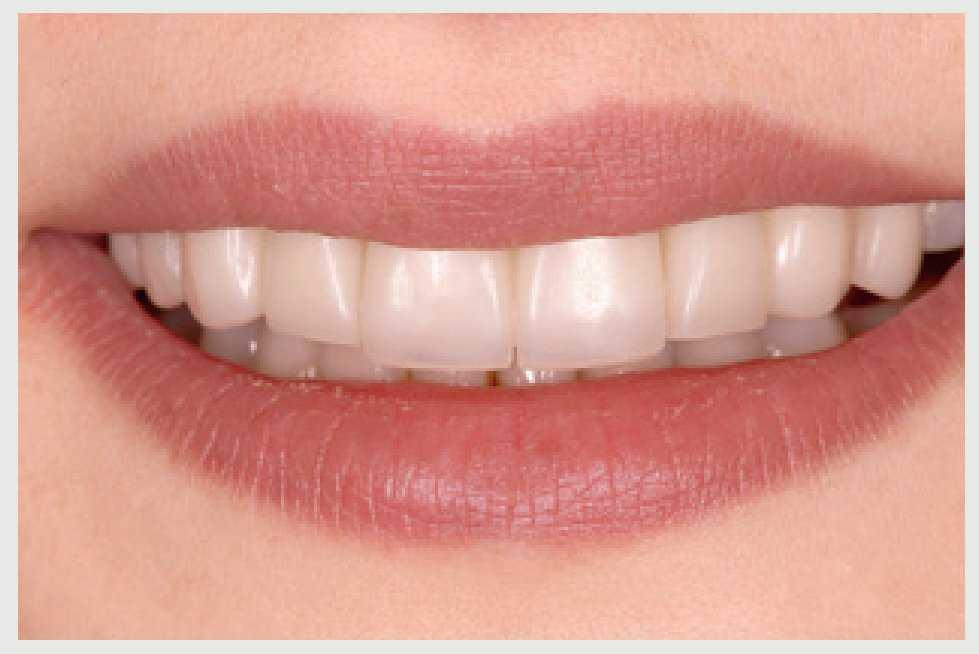 Insuficiente exposición dentaria en el sector anterior Presentación de un caso The European