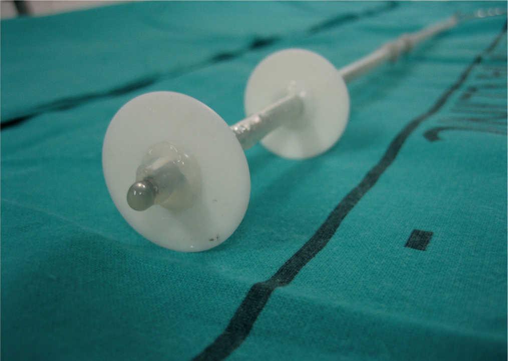 laparoscopic removal of peritoneal dialysis catheter cpt code