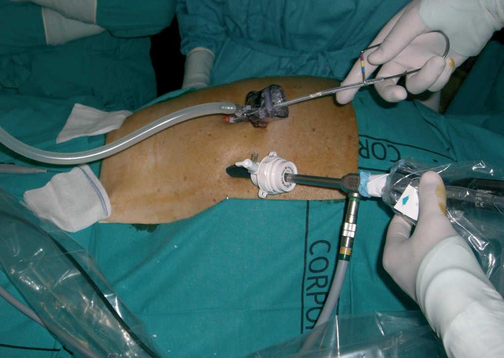 peritoneal dialysis catheter insertion