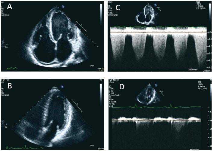 Echocardiographic features of left ventricular dysfunction and outcomes in  chronic kidney disease