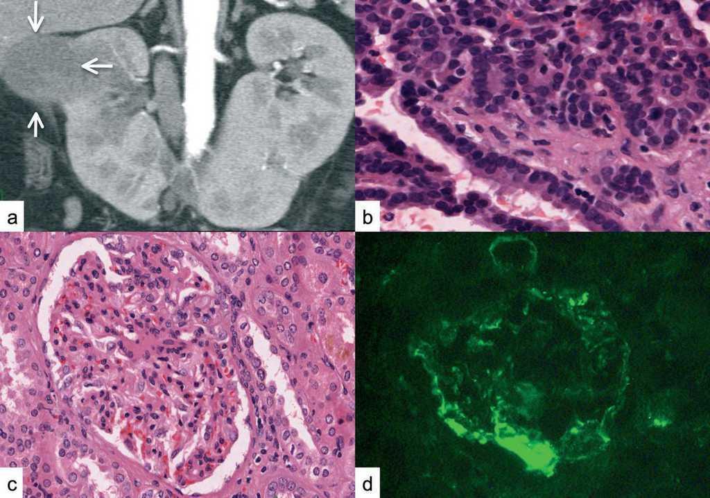 "Horseshoe kidney", renal adenocarcinoma and nephrotic syndrome