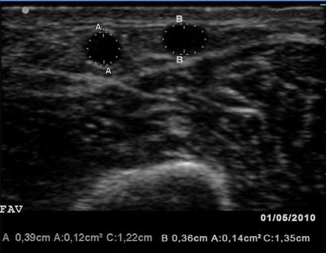 Doppler vascular mapping in Arterio Venous Fistula (AVF)