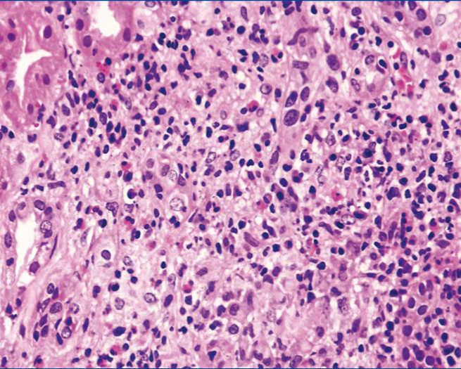 Dress syndrome and acute tubulointerstitial nephritis after treatment ...