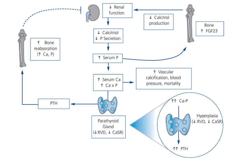 Hiperparatiroidismo cetosis Hiperparatiroidismo cetosis