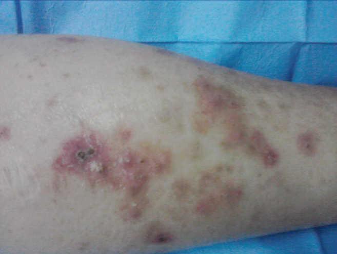Catástrofe persuadir Ponte de pie en su lugar Acquired perforating dermatosis in patients with chronic renal failure. A  report of two cases and a review of the literature | Nefrología