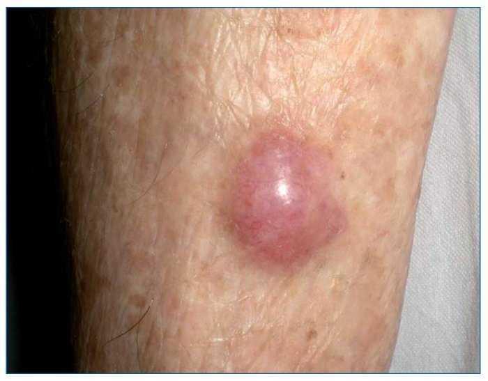 sarcoma cancer de piel seminte de dovleac viermi