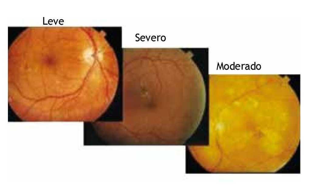 Glaukómakezelés fényterápia