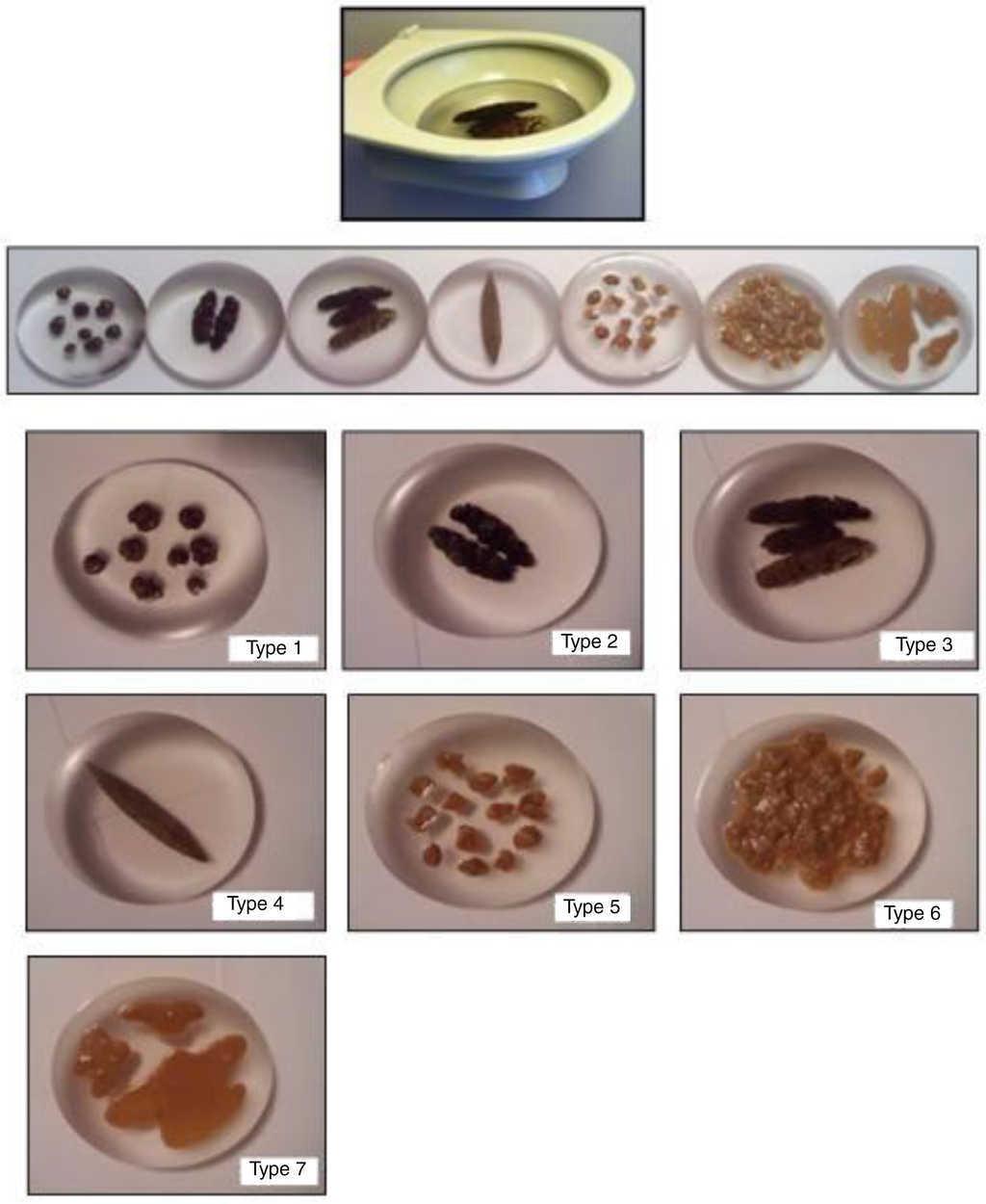 types of stool