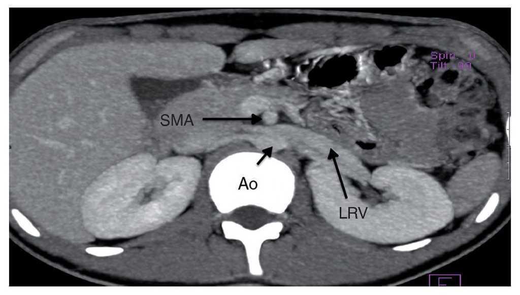 Nutcracker syndrome Cause of nonglomerular hematuria and massive