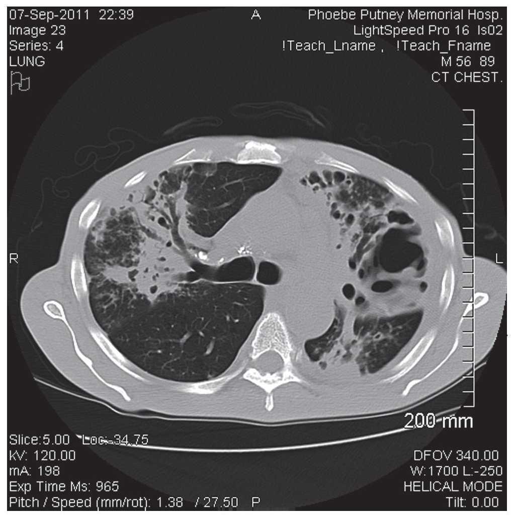 Aerobic Actinomycetes That Masquerade As Pulmonary Tuberculosis Boletin Medico Del Hospital Infantil De Mexico English Edition