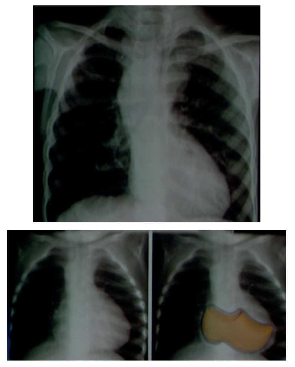 Postoperative Cytomegalovirus Necrotizing Pneumonia In A Preschooler With Tetralogy Of Fallot Boletin Medico Del Hospital Infantil De Mexico English Edition