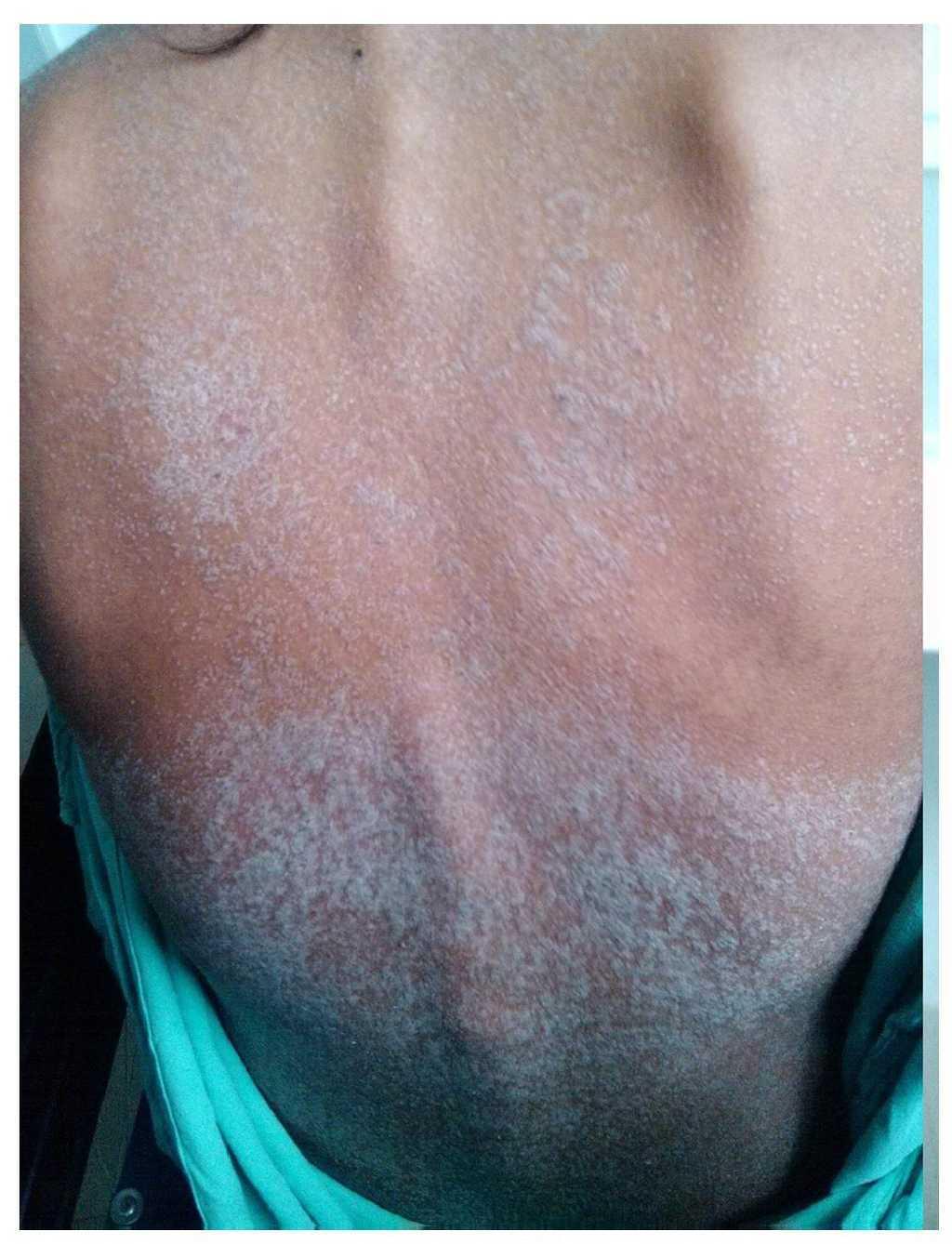 DRESS syndrome associated with carbamazepine | Boletín Médico del