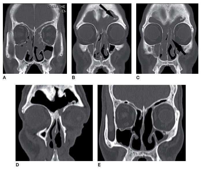 papiloma nasal tomografia)