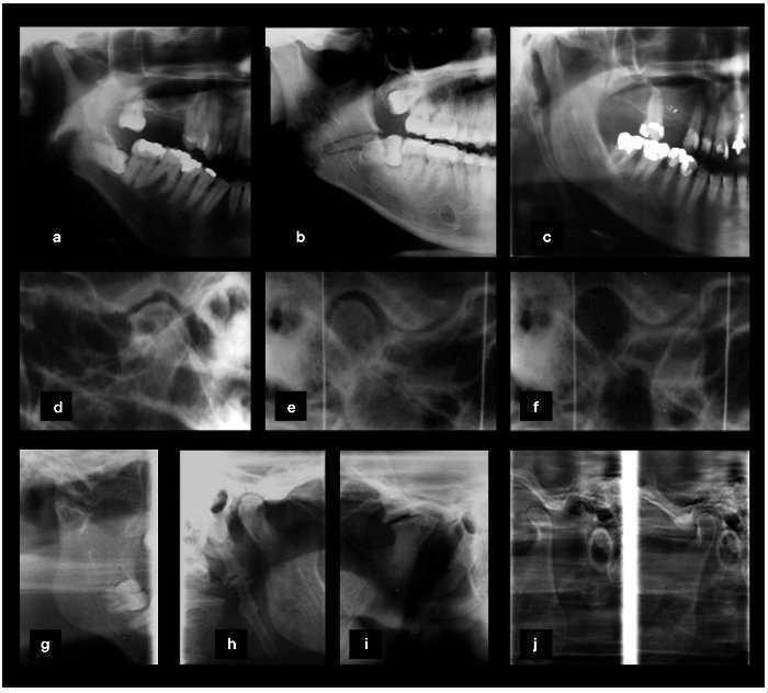 D.T.M. (Disfunção da Articulação Temporomandibular)