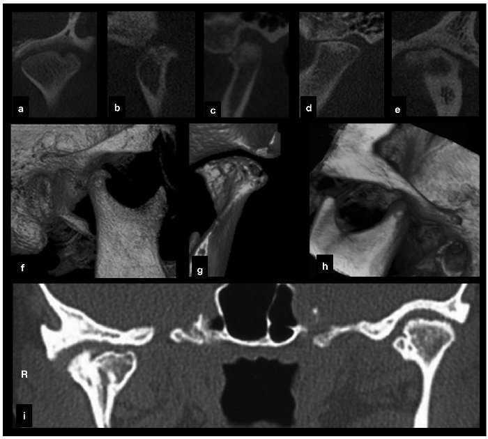 Referência em Bucomaxilofacial: ATM: Os principais sintomas das disfunções  da articulação temporomandibular (DTM)