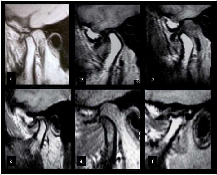 Referência em Bucomaxilofacial: ATM: Os principais sintomas das disfunções  da articulação temporomandibular (DTM)