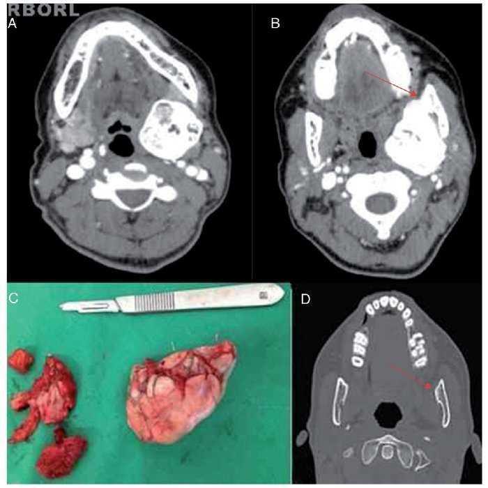 De uma Mandíbula Travada para a Osteoartrite: Descoberta do Hadassah Leva a  Novo Tratamento - Hadassah Brasil