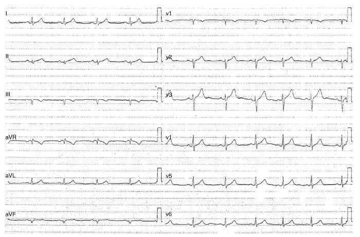 Fibrosi miocàrdica i extrasistòlia ventricular. Cas clínic | Apunts ...