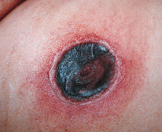 Mucormicosis Diseminada En Una Paciente Con Leucemia Mieloblastica Aguda Actas Dermo Sifiliograficas