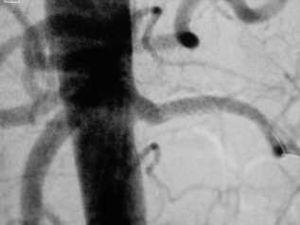 Doppler renal hta