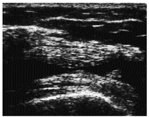 Role Of Ultrasound In Osteoarthritis | Revista Española De Reumatología