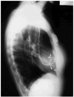 Tricuspid Stenosis after Pacemaker Implantation Without Evidence of ...