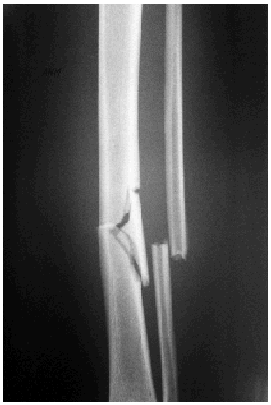 Tratamiento De Las Fracturas Cerradas De La Diáfisis Tibial Mediante ...