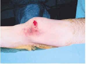 Fracción tinta En particular Luxación lateral irreductible de rodilla | Revista de la Sociedad Andaluza  de Traumatología y Ortopedia