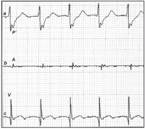 Arrhythmia Induction During Atrial Pacing With Atrial «Floating ...