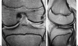 Menisco Discoideo: Valor Pronóstico Del Grosor Meniscal | Revista ...