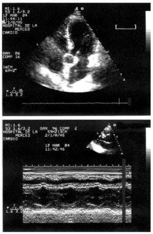 Asymmetric Septal Hypertrophy Associated With «Subclinical ...