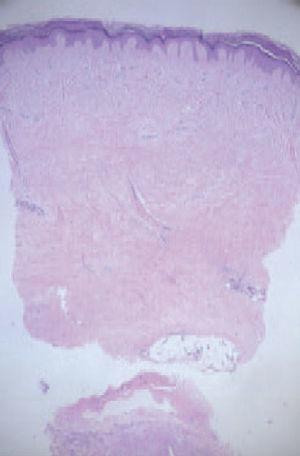 Síndrome esclerodermiforme por paclitaxel | Actas Dermo-Sifiliográficas