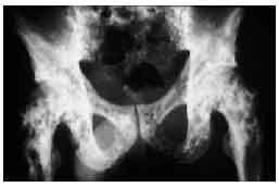 kenőcsök a vállízület osteochondrosisához laser prostate surgery vs turp