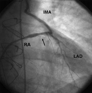 Percutaneous Intervention to a Radial Coronary Artery Graft. Initial ...