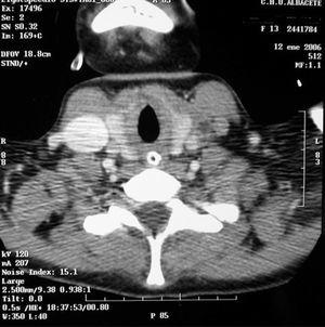 Síndrome de Lemierre | Anales de Pediatría