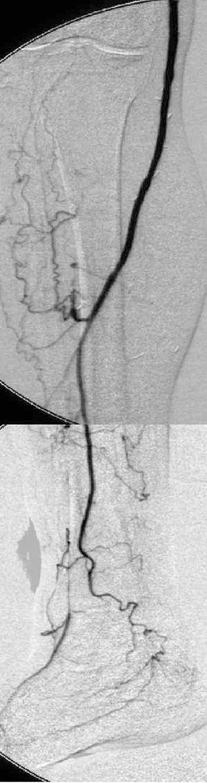 case study 16 multiple patients with peripheral vascular disease