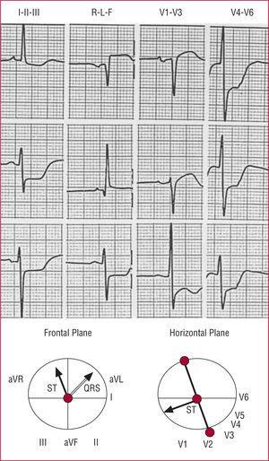 Electrocardiographic Diagnosis of Left Main Coronary Artery Obstruction ...