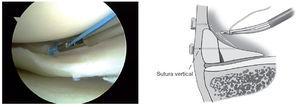 Reparación Meniscal Artroscópica Con Sistema De Sutura Completamente ...