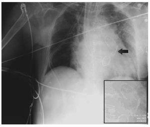 Multiple Knotting of a Swan-Ganz Catheter | Revista Española de Cardiología