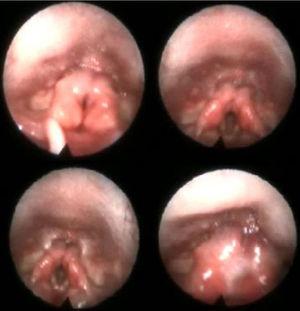 Videoendoscopia caso 1 donde se aprecia mucosa de aritenoides mamelonada hipertrófica secundaria al defecto.