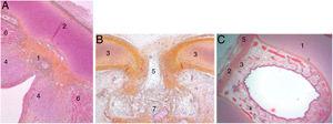 Secciones transversales de un feto de 25 semanas (hematoxilina-eosina) cerca del plano glótico (A), en el borde superior del cartílago tiroides (B) y cerca del borde superior del cartílago cricoides (C). A y B. 1. Malla de haces de fibras de colágeno en la comisura anterior; 2. Lámina intermedia del cartílago tiroides; 3. Lámina lateral del cartílago tiroides; 4. Mácula flava; 5. Escotadura del cartílago tiroides; 6. Fibras musculares glóticas; 7. Espacio preepiglótico futuro. C. 1. Cartílago cricoideo; 2. membrana cricotiroidea; 3. Malla de fibras de colágeno verticales; 4. Fibras de colágeno circulares; 5. Músculo cricotiroideo (reproducción de imágenes con permiso del autor).