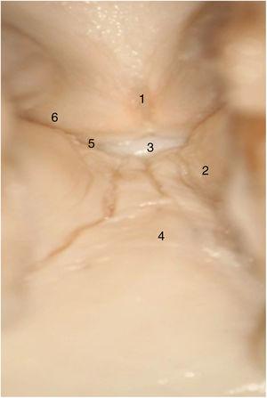 Vista endoscópica de la comisura anterior de la laringe (espécimen adulto). 1. Tendón de Broyles epiglótico; 2. cuerda vocal derecha; 3. hueco medio supraglótico; 4. nivel subglótico; 5. ventrículo laríngeo; 6. banda ventricular izquierda (reproducción de imágenes con permiso del autor).