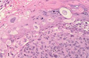 Carcinoma espinocelular en la zona inferior y células de epidermodisplasia verruciforme en la zona superior (hematoxilina-eosina ×400).