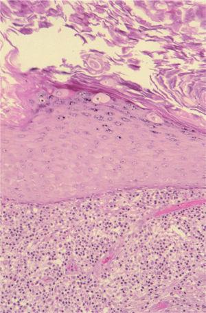 Células de epidermodisplasia verruciforme aisladas en la capa granulosa de la epidermis, junto a otros signos histológicos indirectos de infección por el VPH (hematoxilina-eosina ×200).