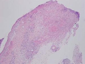 Hematoxilina-eosina, ×10. Úlcera con un denso infiltrado inflamatorio neutrofílico y presencia de vasos con necrosis fibrinoide.