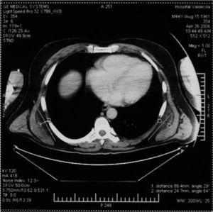 Corte axial de tomografía computarizada que muestra una tumoración bilateral subescapular con áreas isodensas respecto al músculo y zonas de menor densidad correspondientes a la grasa característica del elastofibroma.