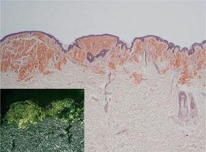 Amiloidosis nodular. Masas de amiloide de color rojo-anaranjado en la dermis papilar, extendiéndose hacia la dermis reticular (Rojo Congo x10). A mayor detalle se muestra la característica birrefringencia verde manzana bajo luz polarizada.
