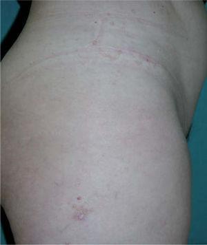 Lesión en el muslo derecho y pápulas en torno a la cicatriz del flanco derecho.