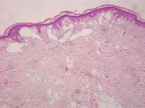 Epidermis acantósica con hiperqueratosis y papilomatosis; en la dermis superficial, se observan estructuras vasculares dilatadas. Hematoxilina-eosina, ×40.